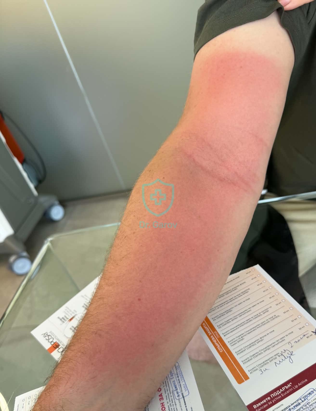 Erythema solare