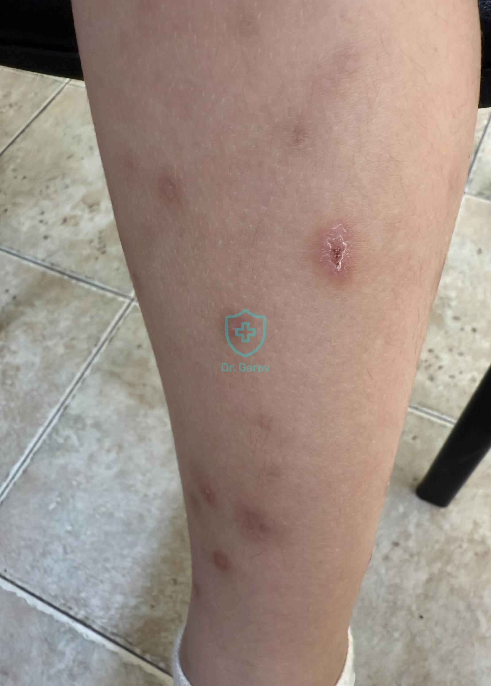 Pruritus neuroticus
