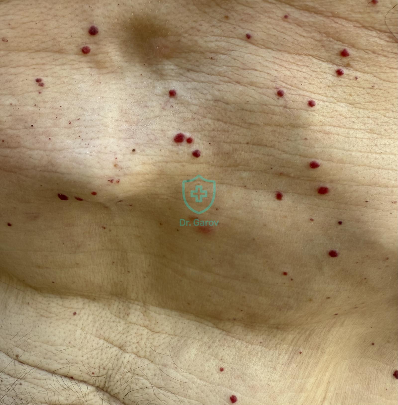 Haemangioma punctiforme