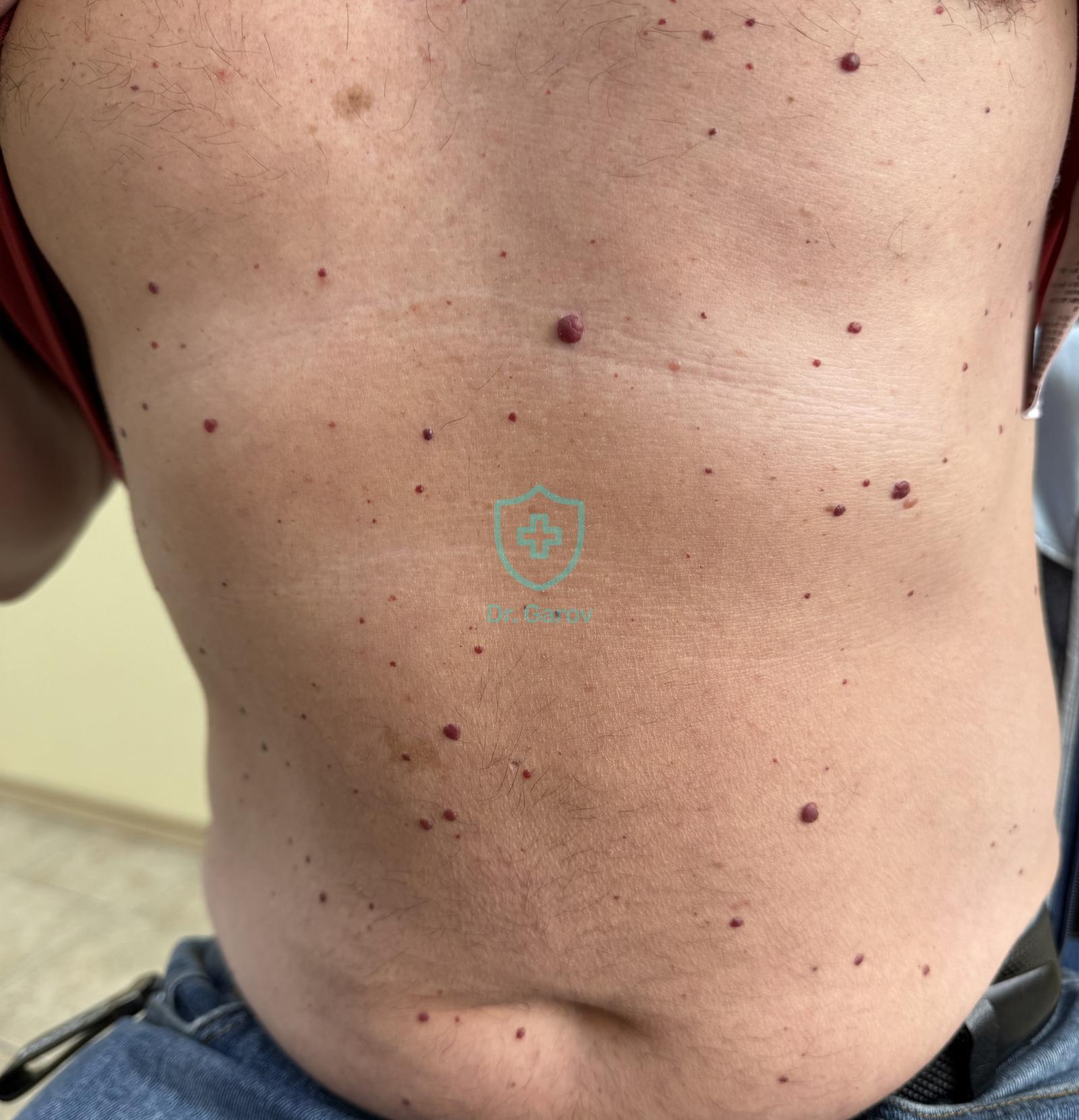 Haemangioma punctiforme