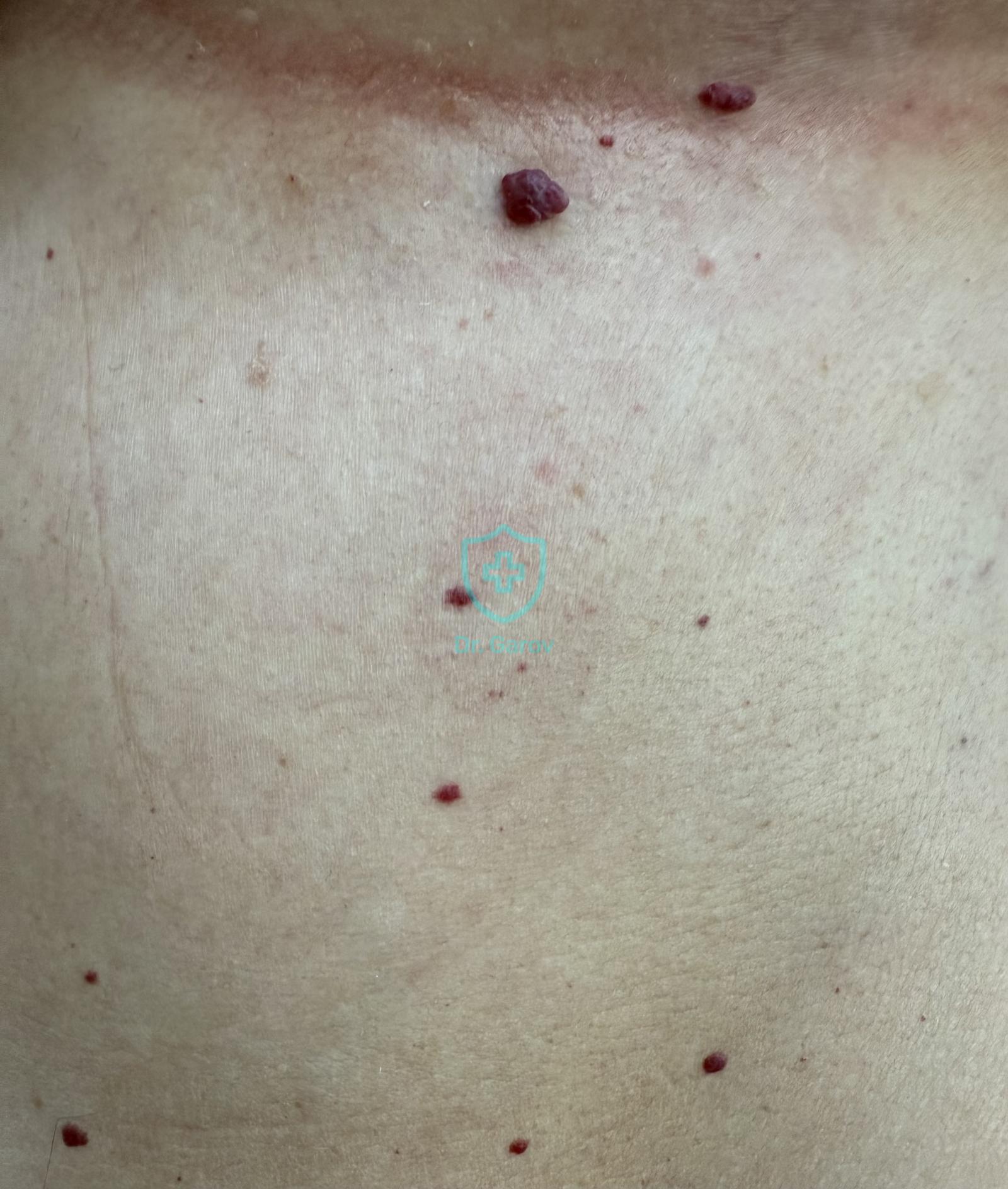 Haemangioma punctiforme