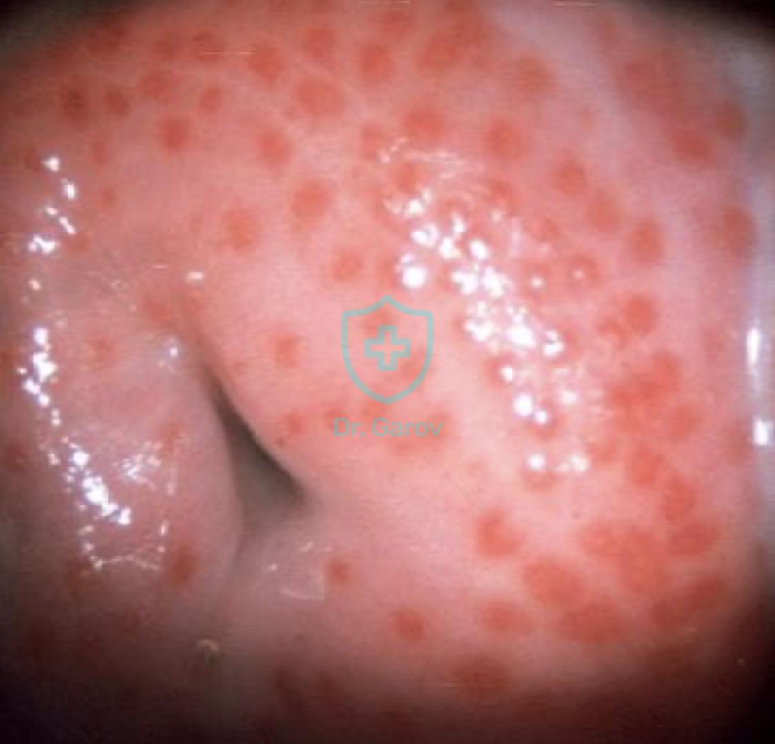 Strowberry cervix