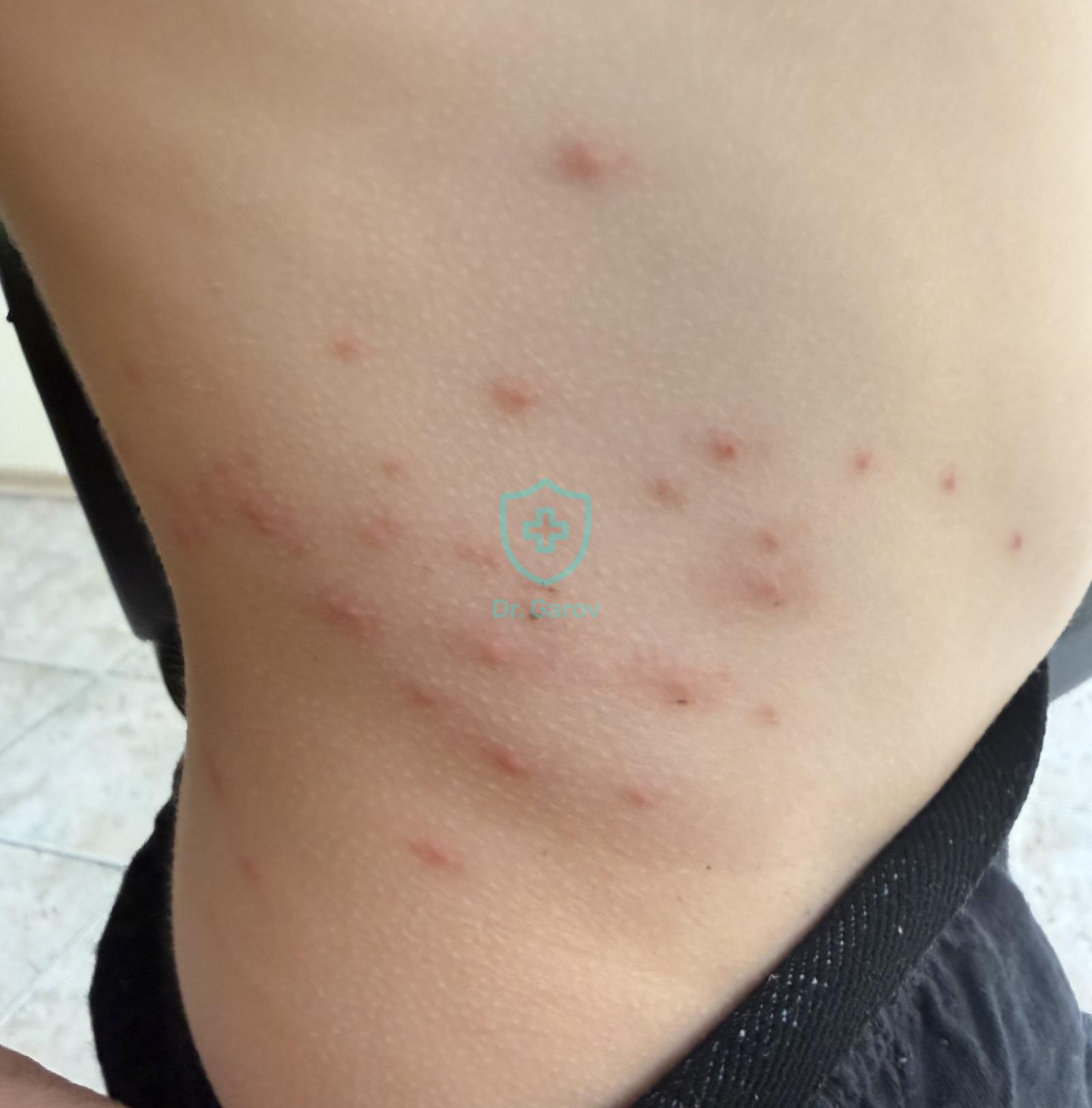 Trombidiasis, тромбидиаза
