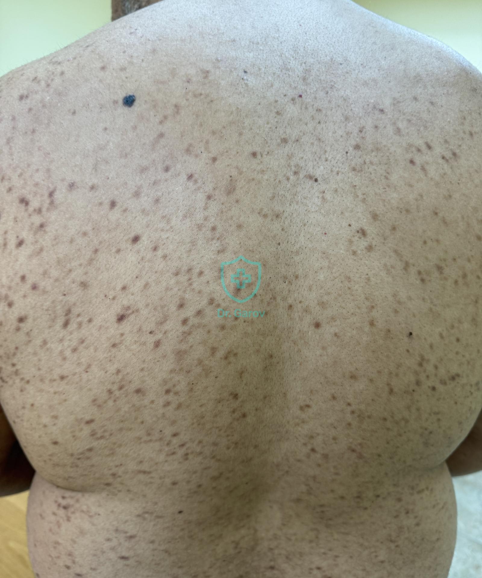Urticaria pigmentosa