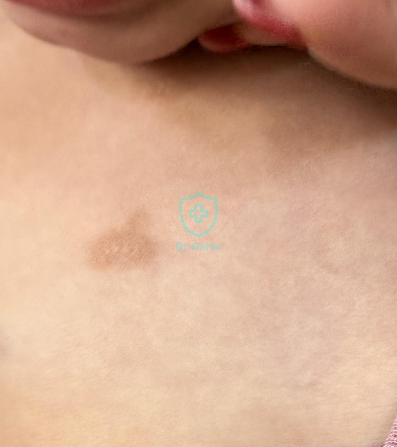 Urticaria pigmentosa