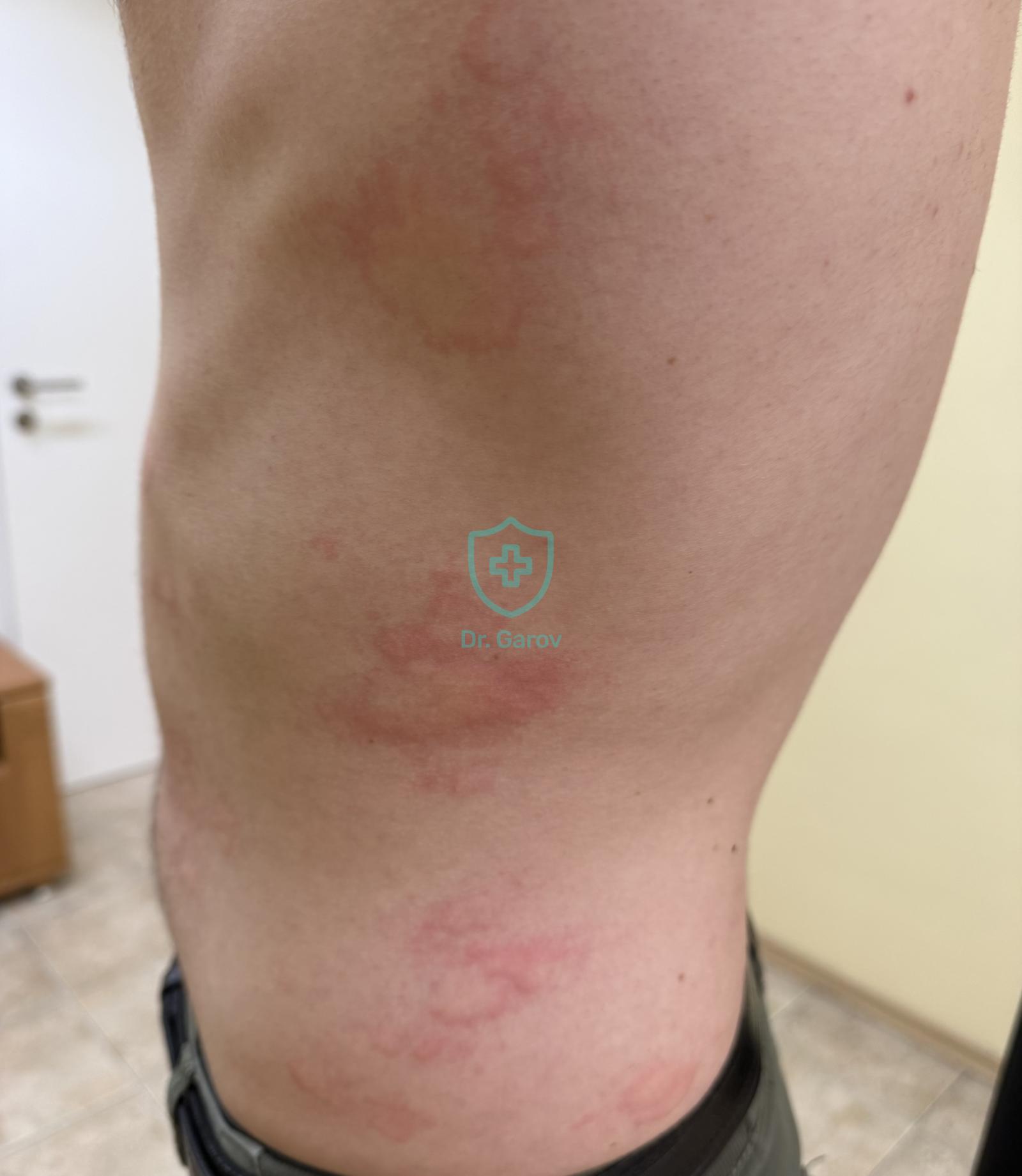 Urticaria