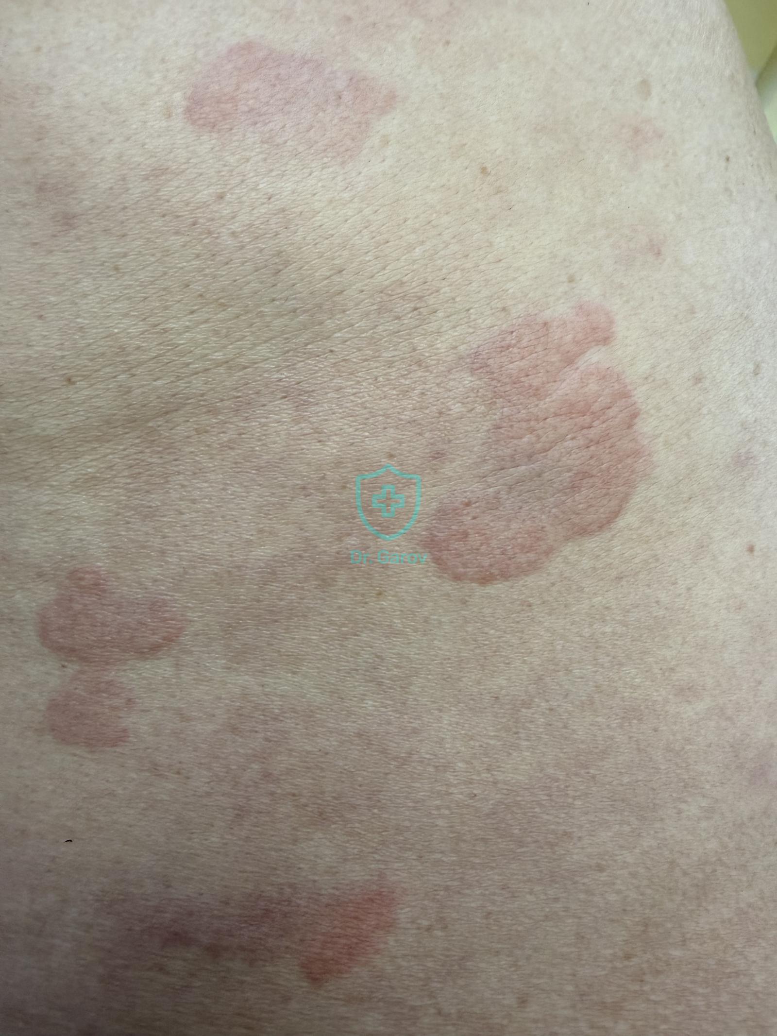Urticaria