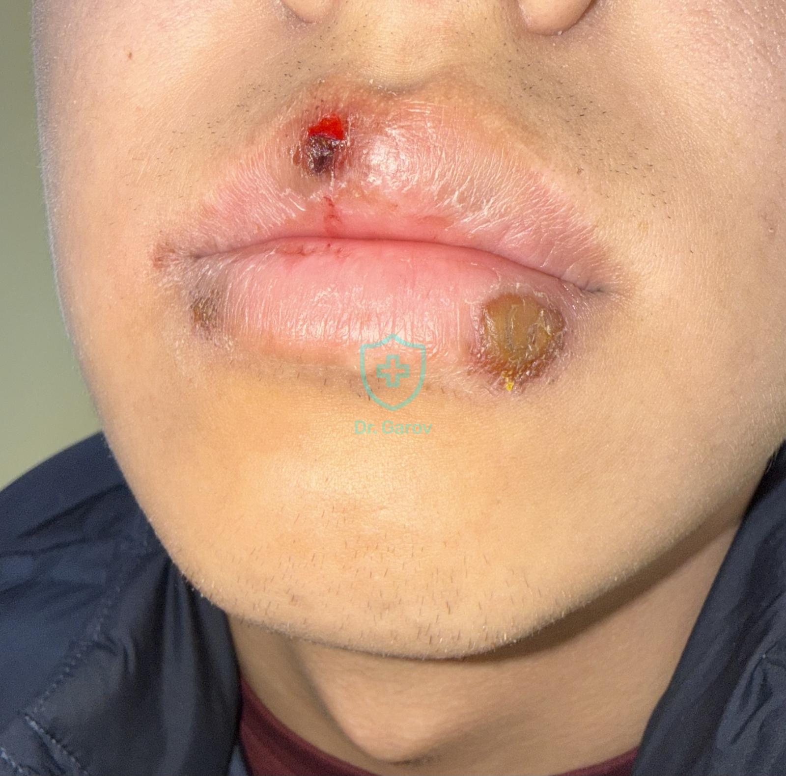 Erythema fixum, еритема фиксум