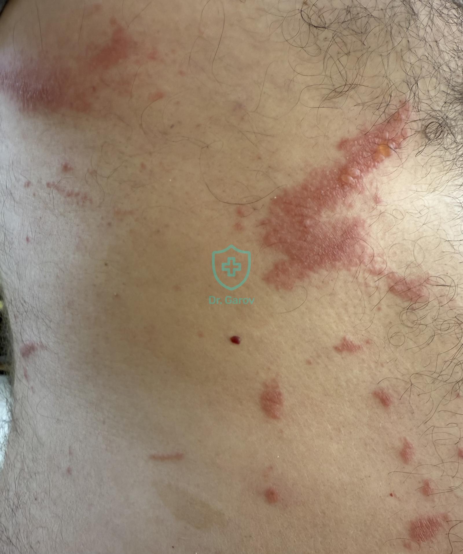 Phytophotodermatitis - Dermatitis pratensis