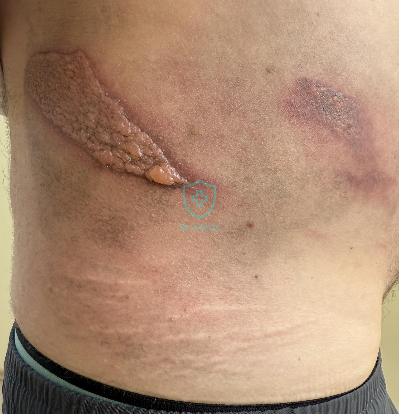 Phytophotodermatitis