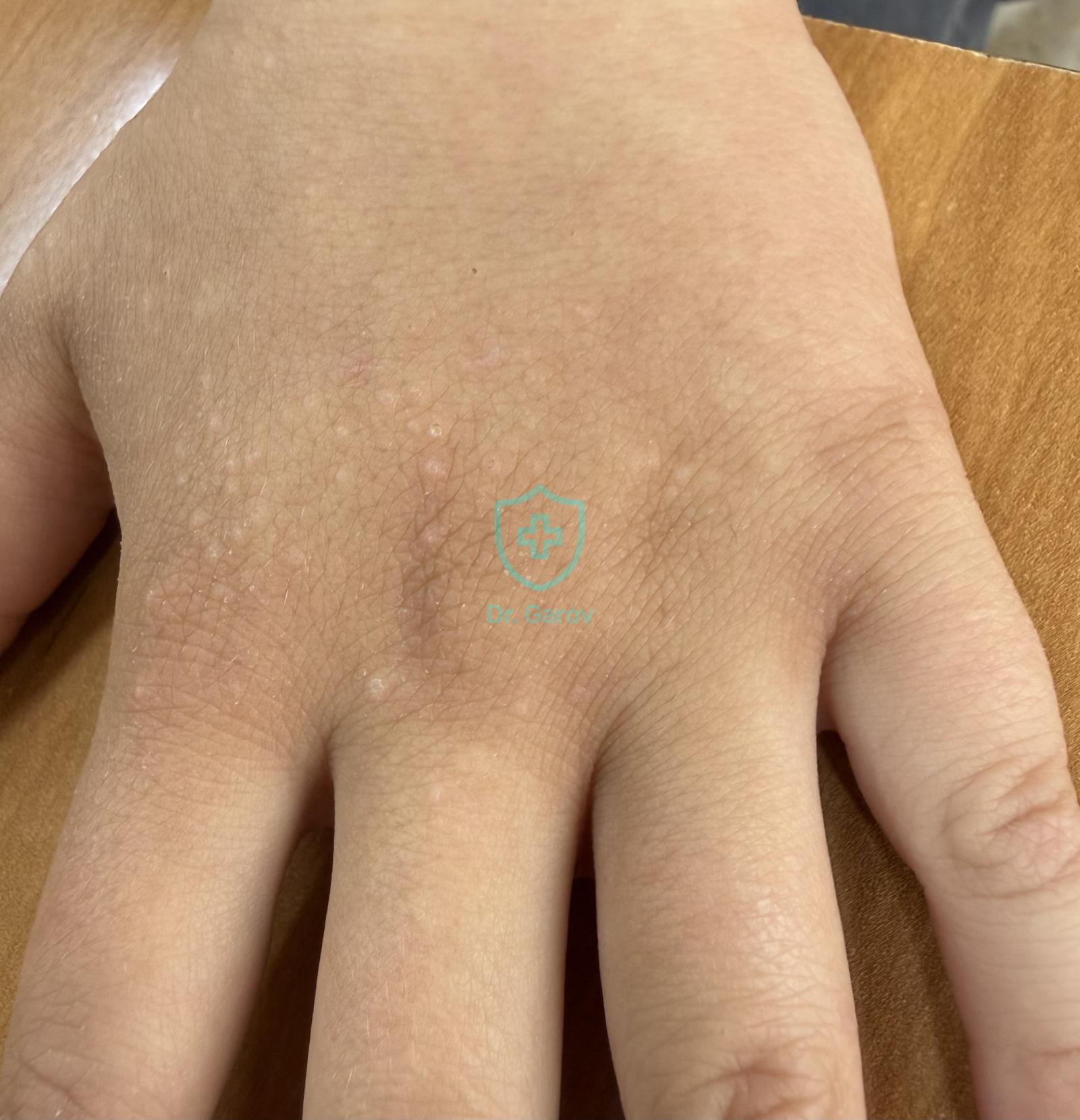 Frictional lichenoid dermatitis, Frictional Dermatitis of children, Dermatitis papulosa juvenilis