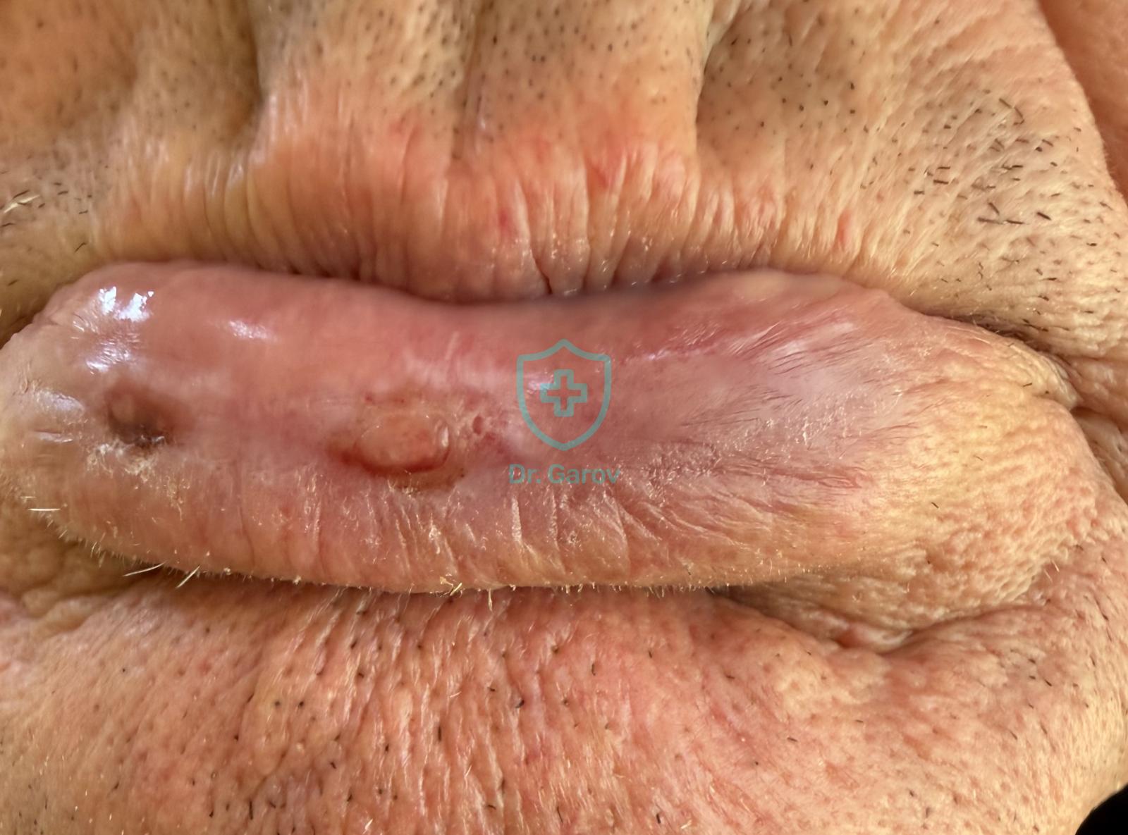 Cheilitis abrasiva praecancerosa
