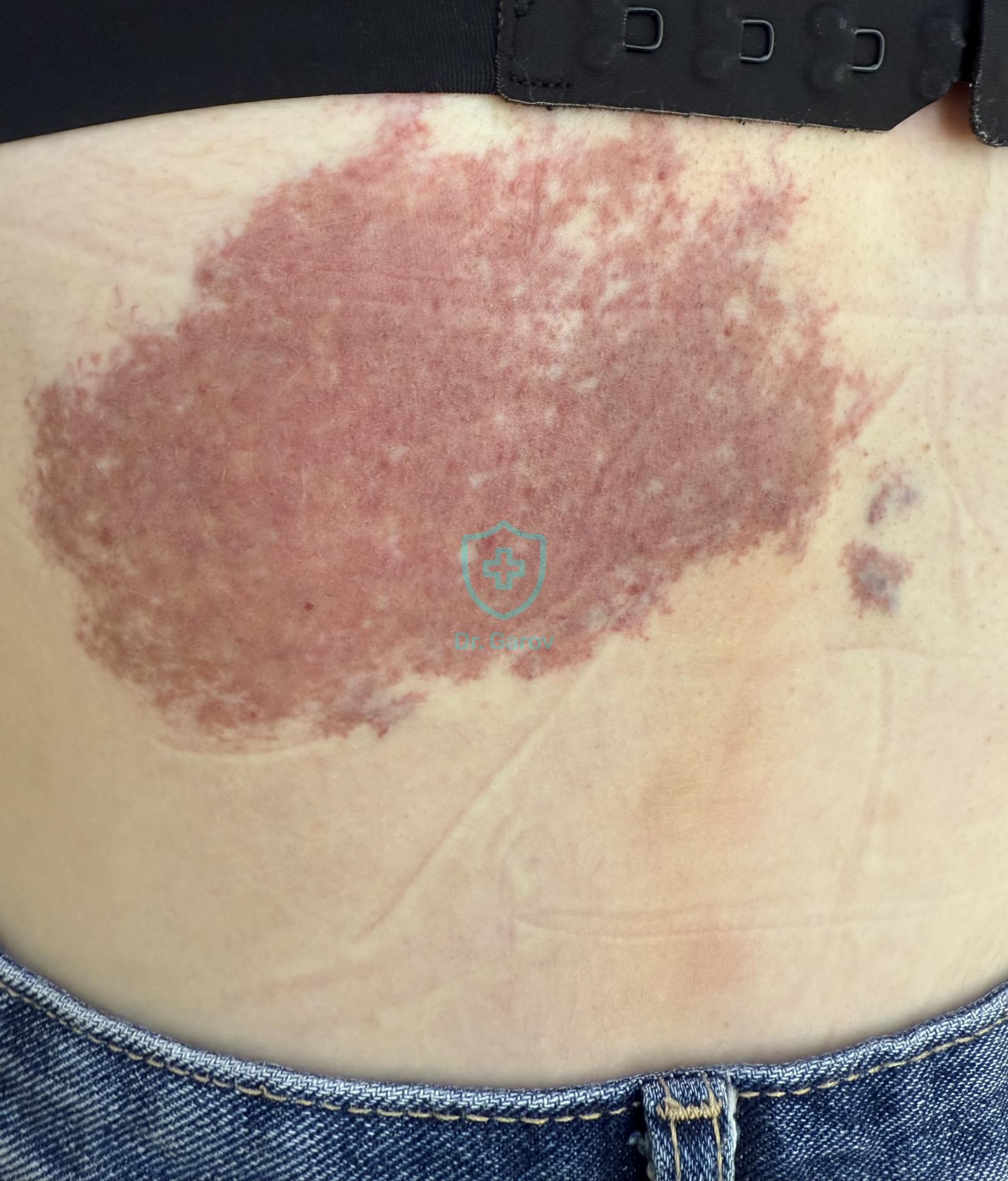 Haemangioma