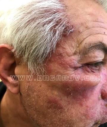 Снимка Херпес-зостер