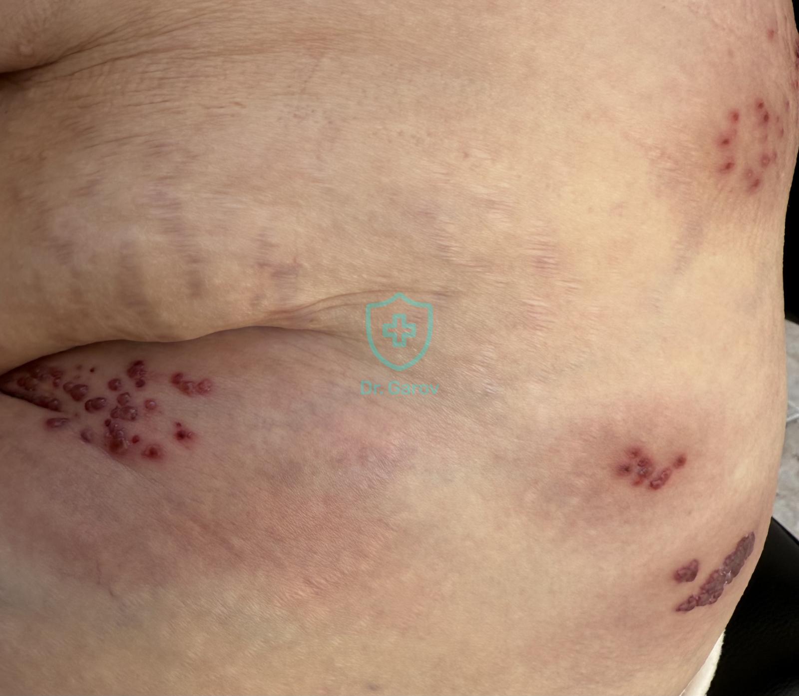 Herpes zoster lumbo-inguinalis
