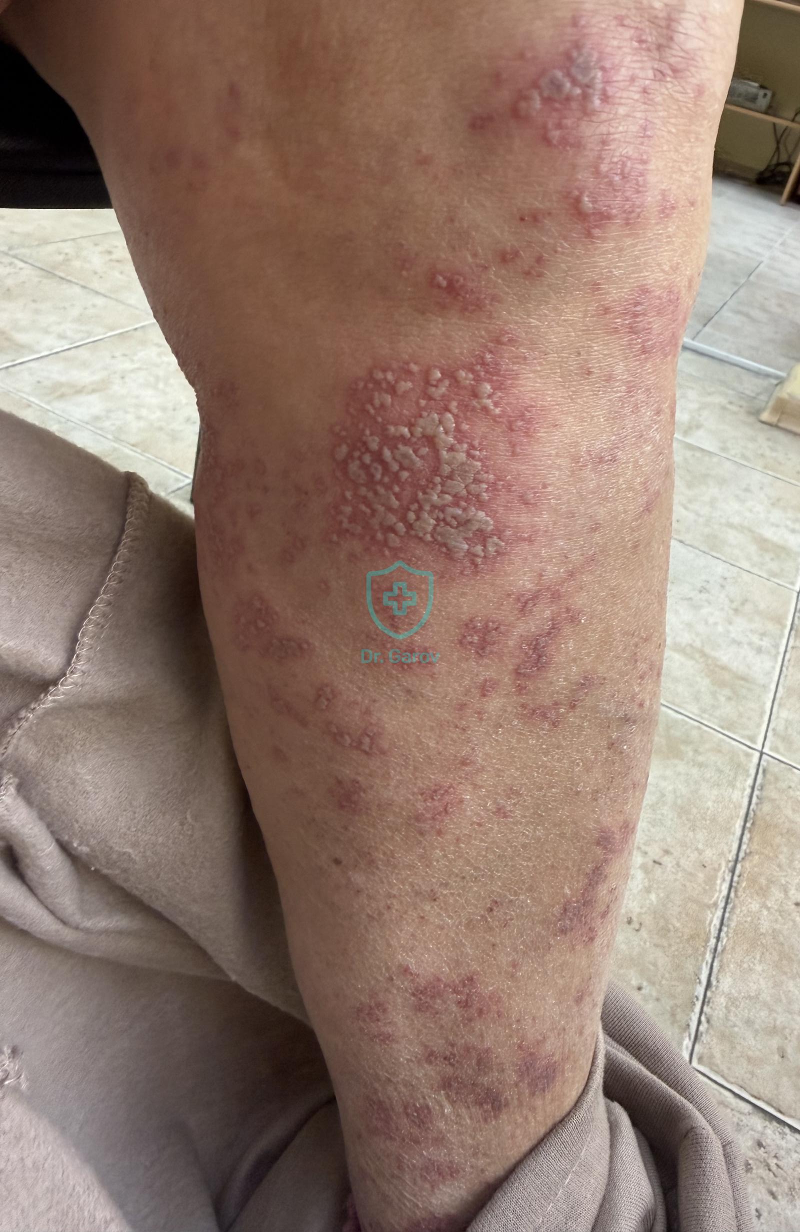Herpes zoster femoralis