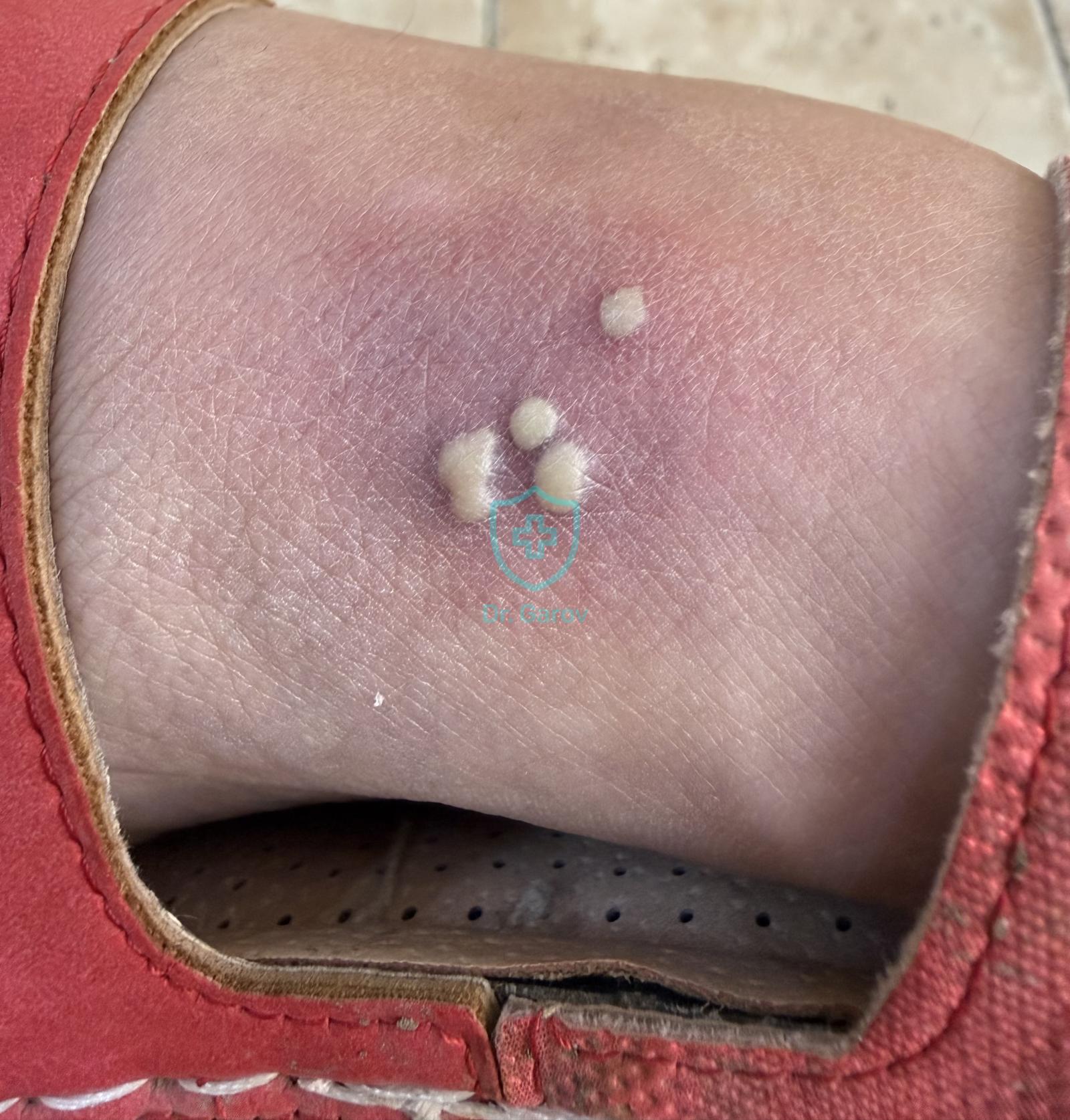 Herpes simplex