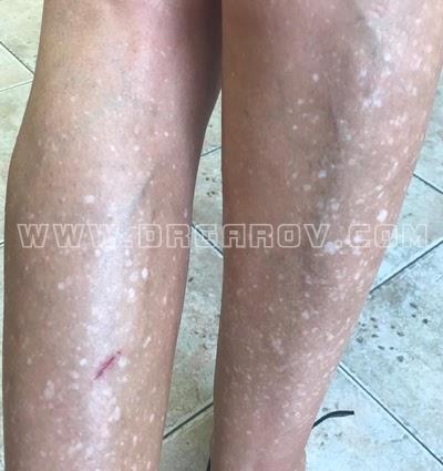 Снимка Хипомеланозис гутата идиопатика