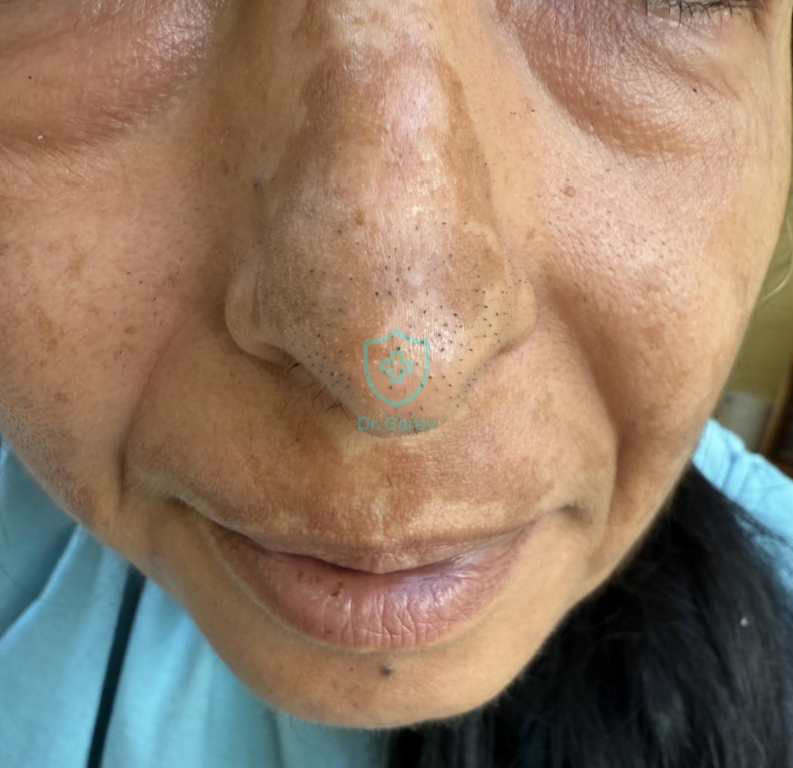 Chloasma, Melasma
