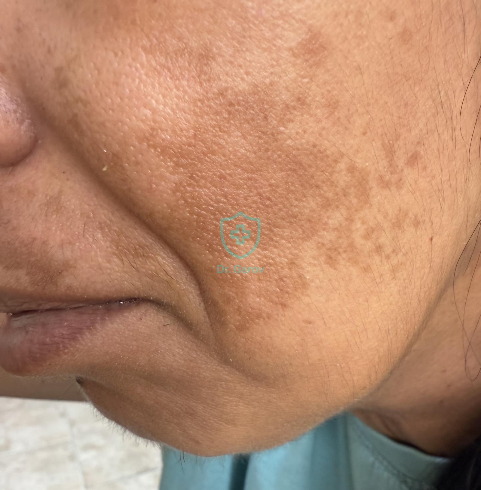 Chloasma, Melasma