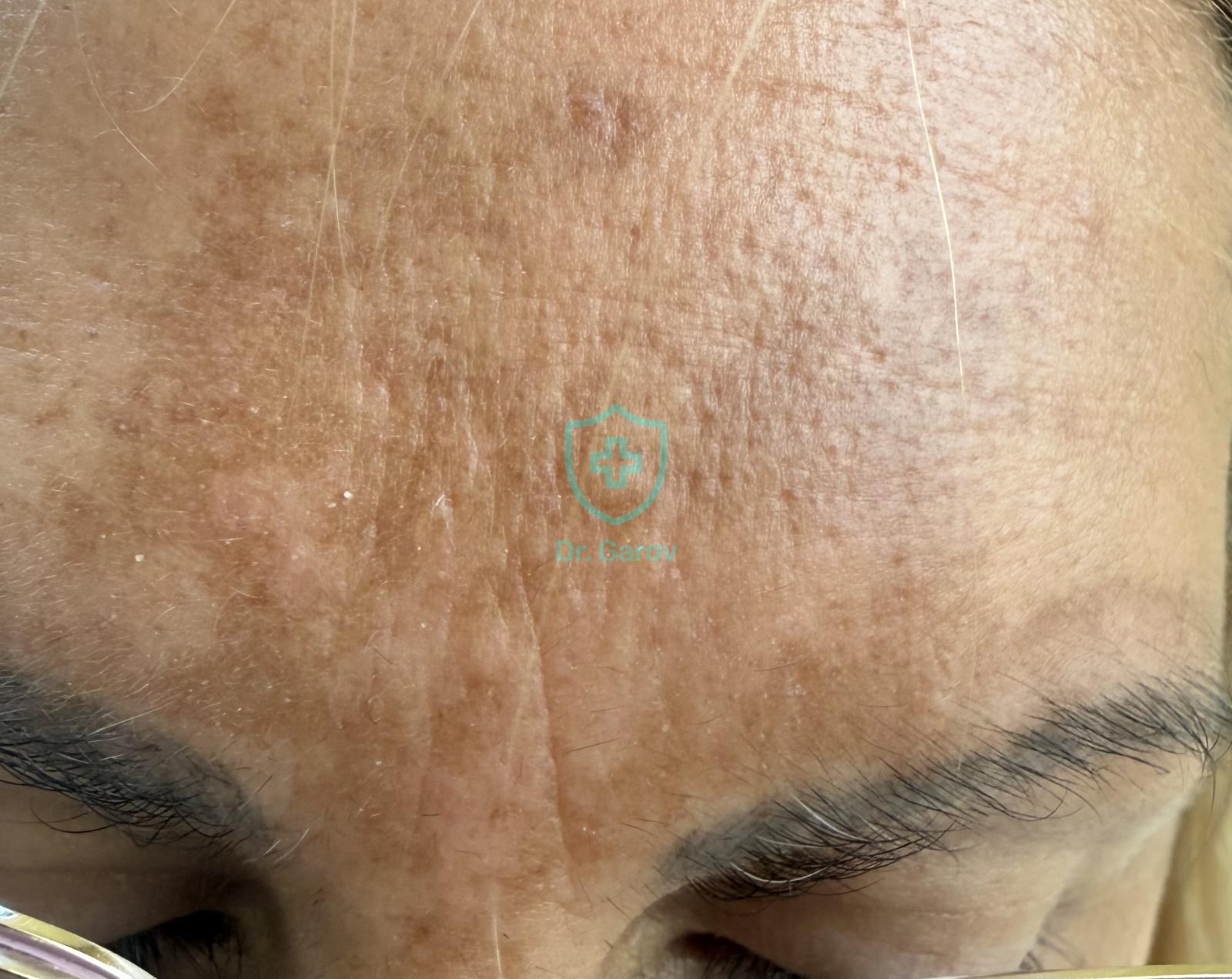 Chloasma, Melasma