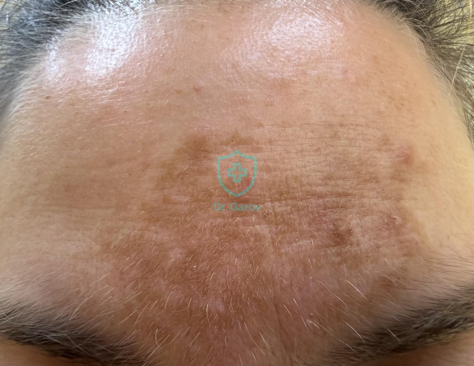 Chloasma, Melasma