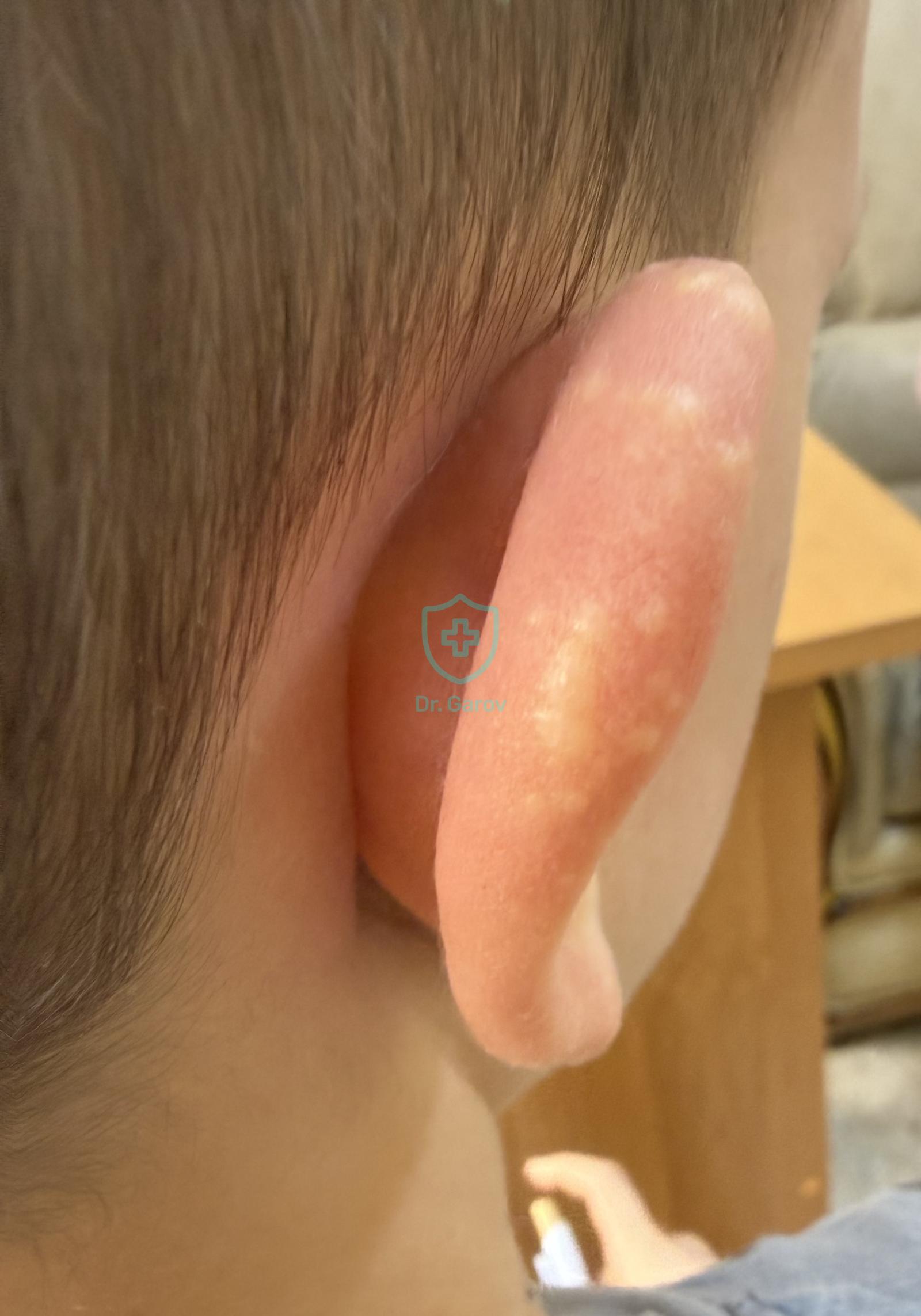 Ювенилна пролетна ерупция, Juvenile Spring Eruption